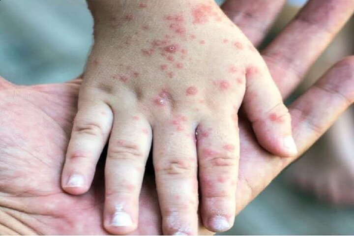 ثبت ۷۱۴ مورد «سرخک» در کشور؛ اوج ابتلا در اردیبهشت ثبت ۷۱۴ مورد «سرخک» در کشور؛ اوج ابتلا در اردیبهشت