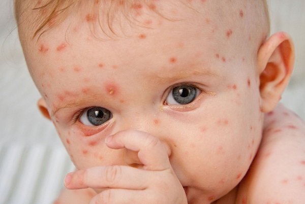 شیوع «آبله مرغان» در بهار شیوع «آبله مرغان» در بهار