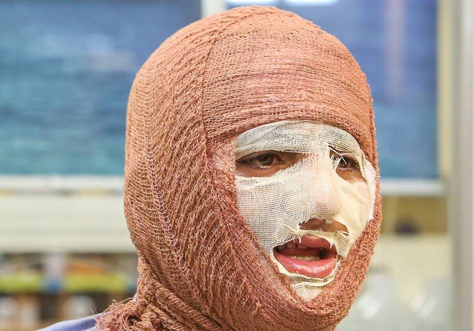 «جان نو» به کمک بیماران سوختگی میآید «جان نو» به کمک بیماران سوختگی میآید